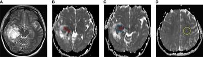 Preoperative and Noninvasive Prediction of Gliomas Histopathological Grades and IDH Molecular Types Using Multiple MRI Characteristics